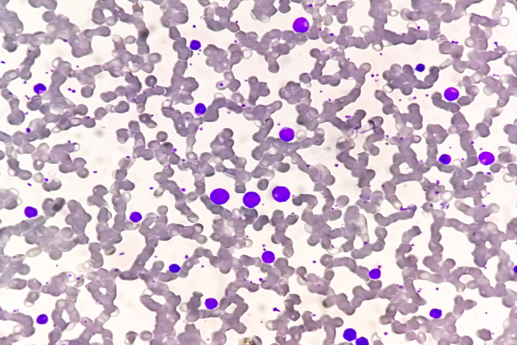 Chronic Leukemias